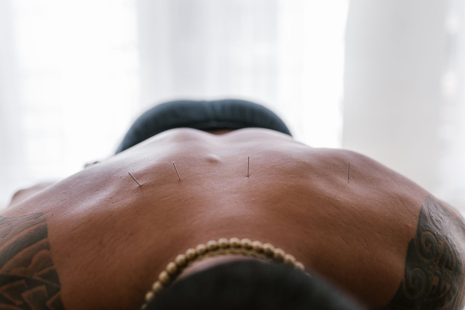 Fine acupuncture needles placed along a client's back